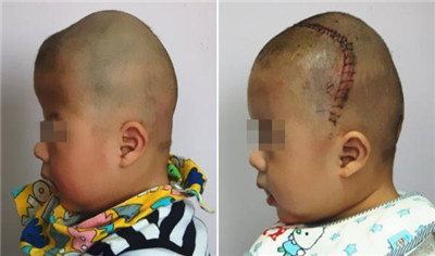 8个月男婴颅骨似外星人 网友:希望罕见疾病远离孩子们