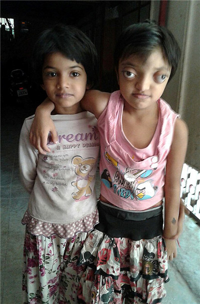 印度女孩患罕见病长”青蛙眼“ 饱受痛苦欺凌