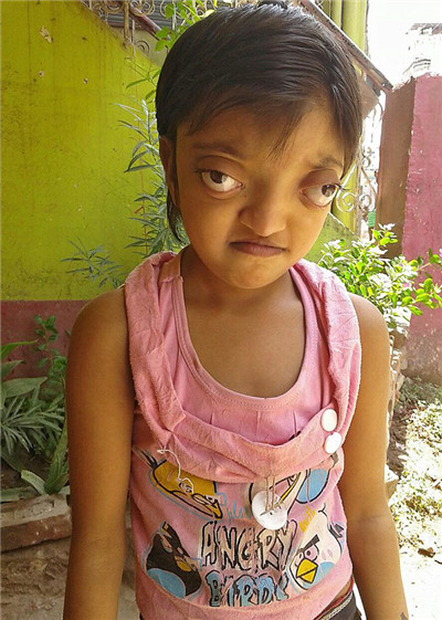印度女孩患罕见病长”青蛙眼“ 饱受痛苦欺凌